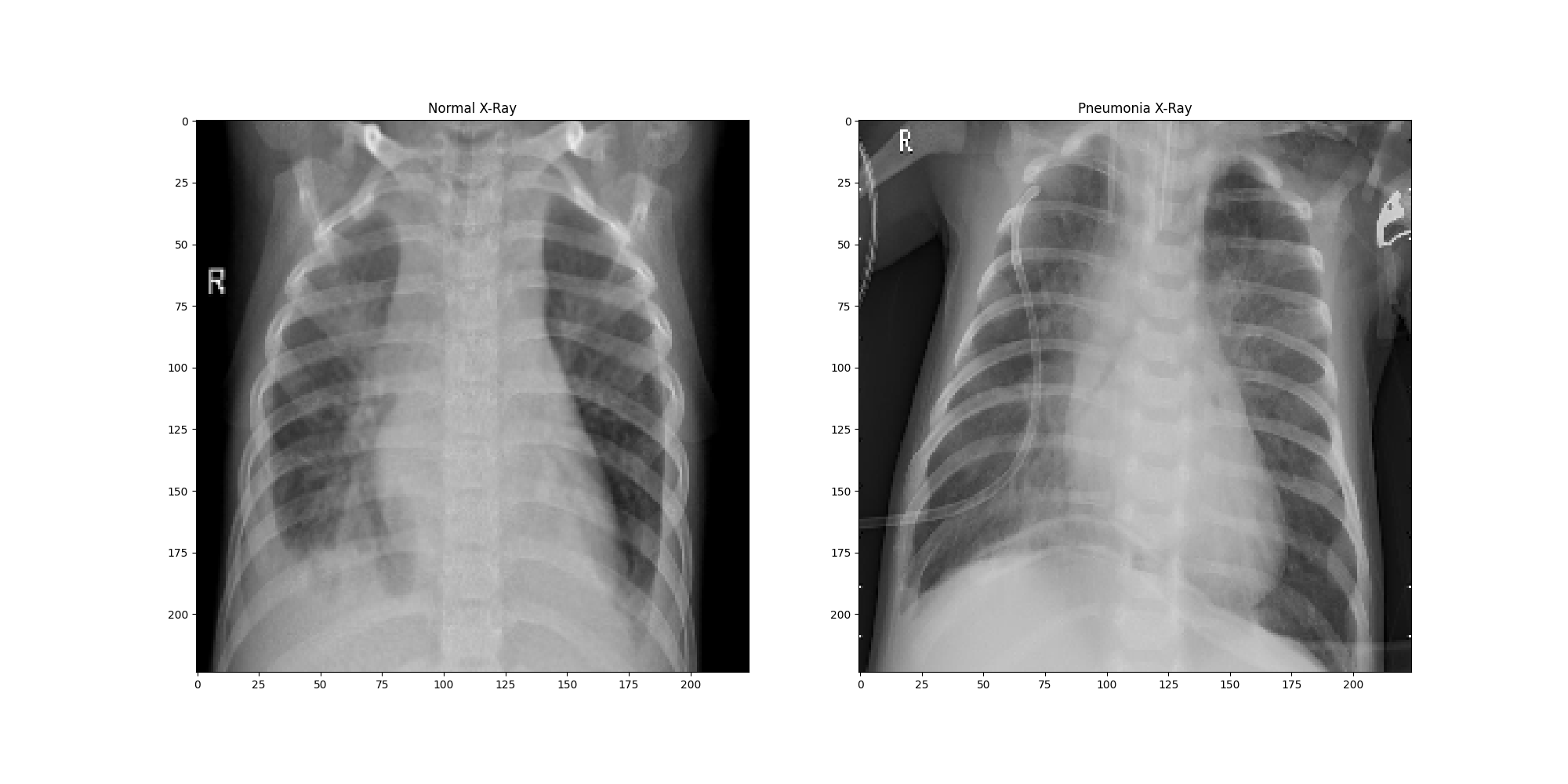 Normal and Pneumonia X-Ray images